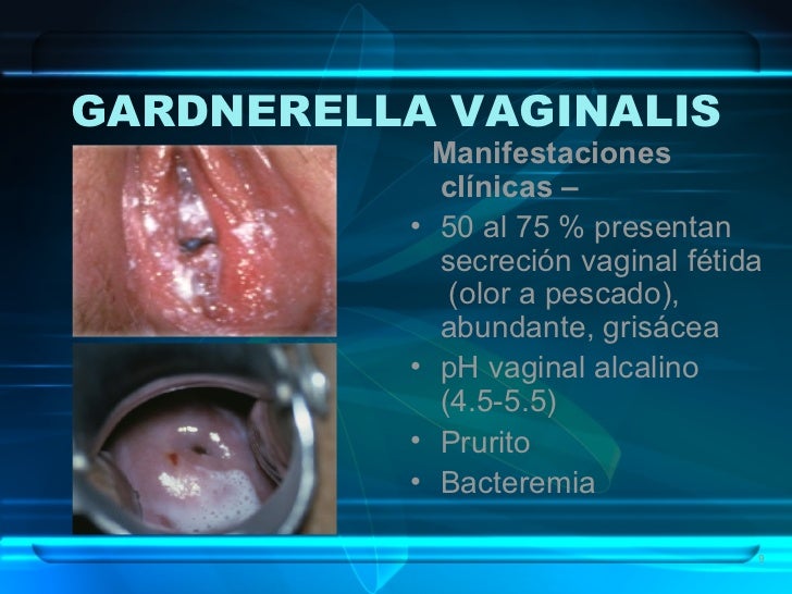 Gardnerella