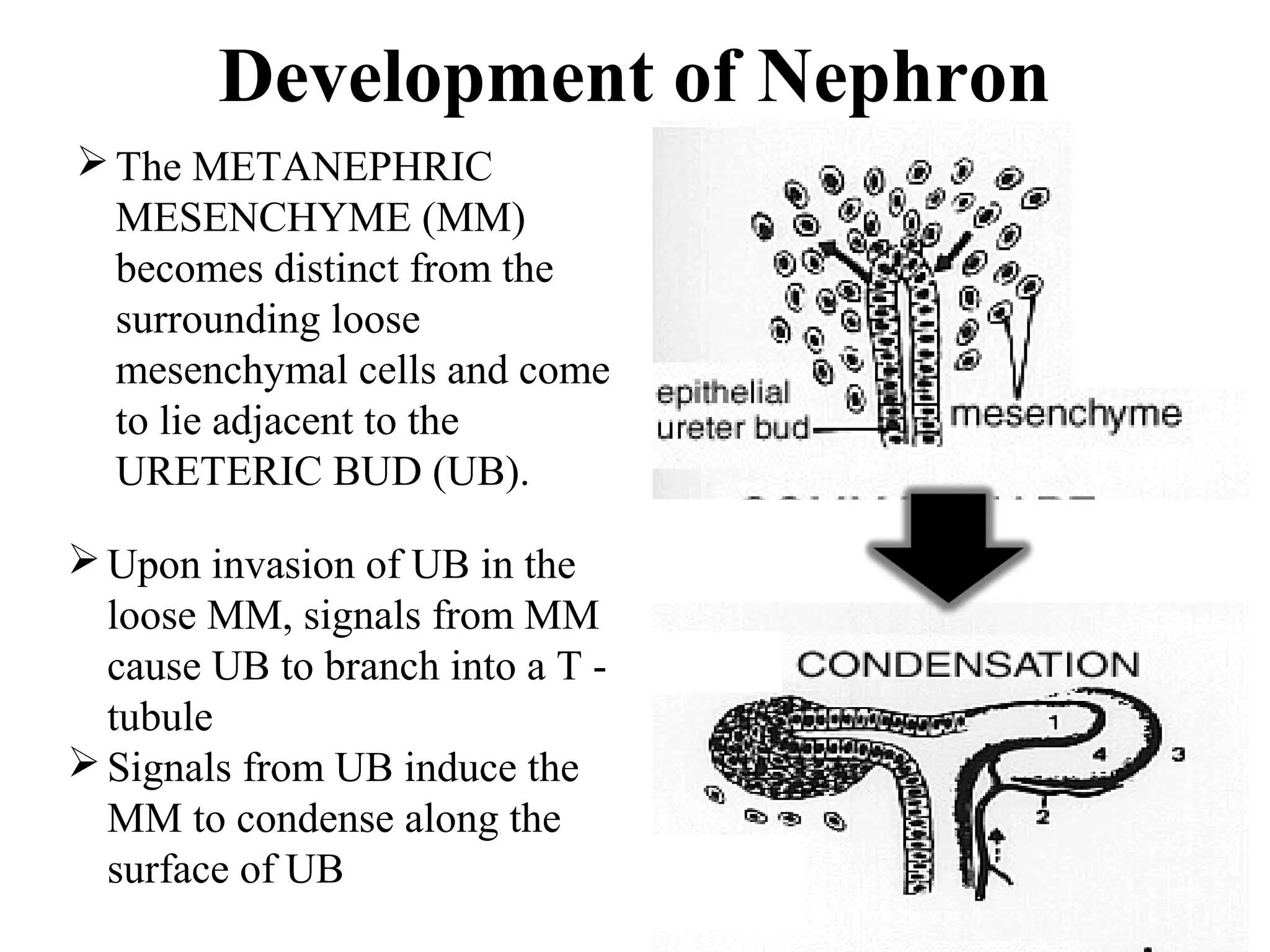 Development of Nephron 
The METANEPHRIC 
MESENCHYME (MM) 
becomes distinct from the 
surrounding loose 
mesenchymal cells and come 
to lie adjacent to the 
URETERIC BUD (UB). 
Upon invasion of UB in the 
loose MM, signals from MM 
cause UB to branch into a T - 
tubule 
Signals from UB induce the 
MM to condense along the 
surface of UB 
 