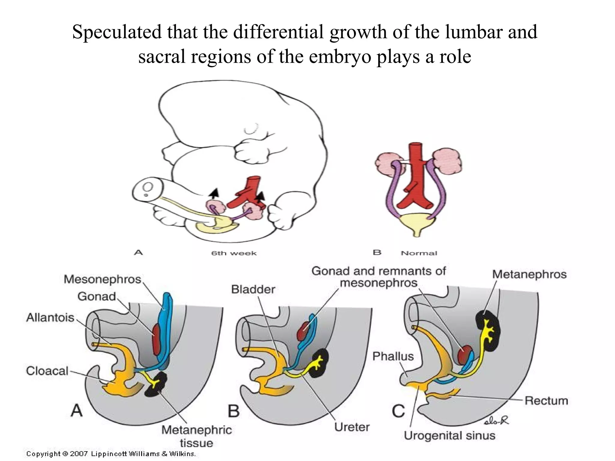 Speculated that the differential growth of the lumbar and 
sacral regions of the embryo plays a role 
 