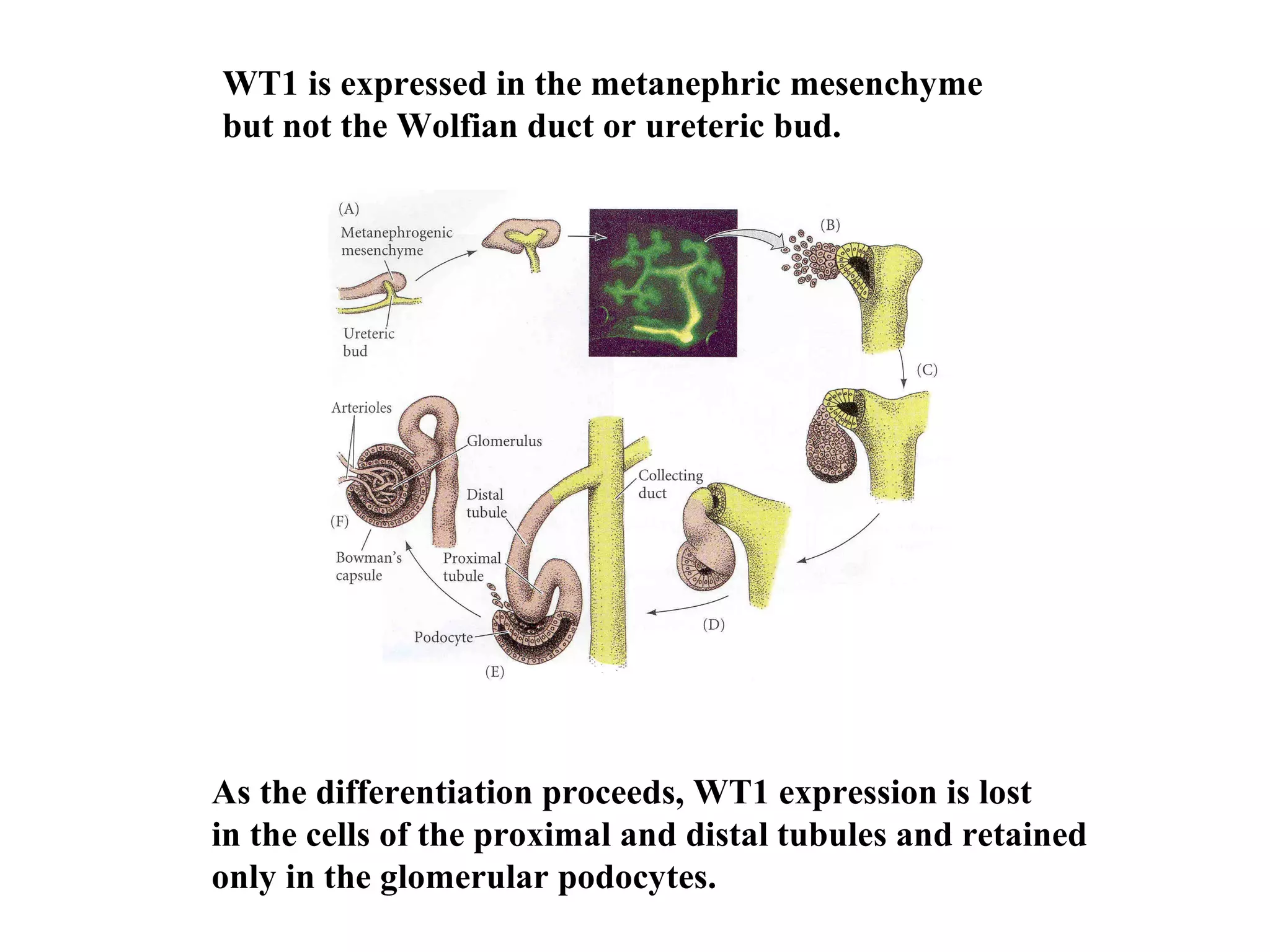 WT1 is expressed in the metanephric mesenchyme 
but not the Wolfian duct or ureteric bud. 
As the differentiation proceeds, WT1 expression is lost 
in the cells of the proximal and distal tubules and retained 
only in the glomerular podocytes. 
 