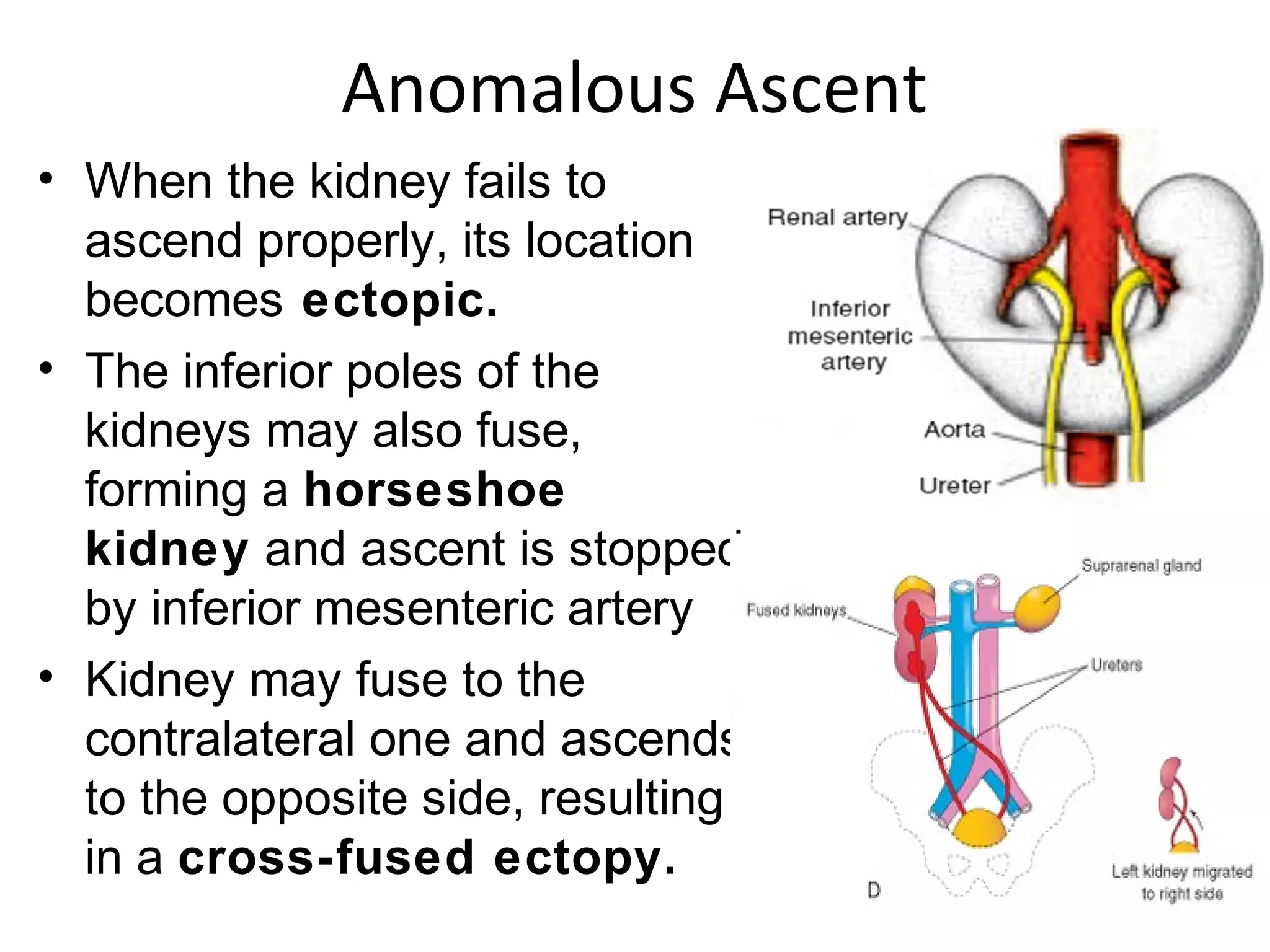 Anomalous Ascent 
• When the kidney fails to 
ascend properly, its location 
becomes ectopic. 
• The inferior poles of the 
kidneys may also fuse, 
forming a horseshoe 
kidney and ascent is stopped 
by inferior mesenteric artery 
• Kidney may fuse to the 
contralateral one and ascends 
to the opposite side, resulting 
in a cross-fused ectopy. 
 