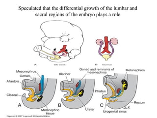 Speculated that the differential growth of the lumbar and 
sacral regions of the embryo plays a role 
 
