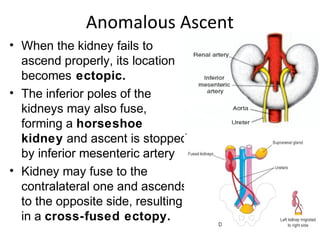 Anomalous Ascent 
• When the kidney fails to 
ascend properly, its location 
becomes ectopic. 
• The inferior poles of the 
kidneys may also fuse, 
forming a horseshoe 
kidney and ascent is stopped 
by inferior mesenteric artery 
• Kidney may fuse to the 
contralateral one and ascends 
to the opposite side, resulting 
in a cross-fused ectopy. 
 