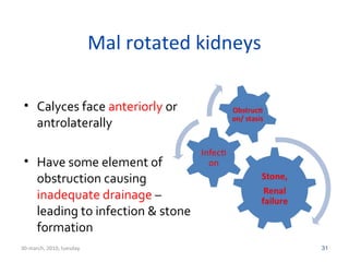 Mal rotated kidneys 
• Calyces face anteriorly or 
antrolaterally 
• Have some element of 
obstruction causing 
inadequate drainage – 
leading to infection & stone 
formation 
30-march, 2010, tuesday 31 
 