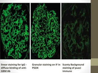 Rpgn Patterns Approach to Rapidly Progressive Glomerulonephritis RPGN | PPTX