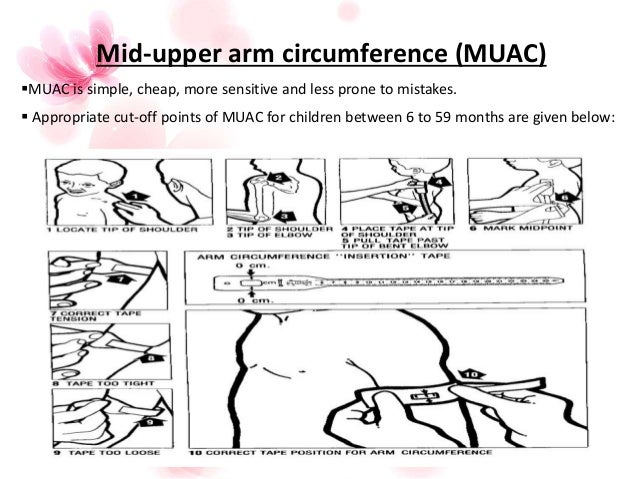 Nutritional assessment- anthropometry