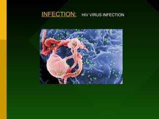 INFECTION:   HIV VIRUS INFECTION
 