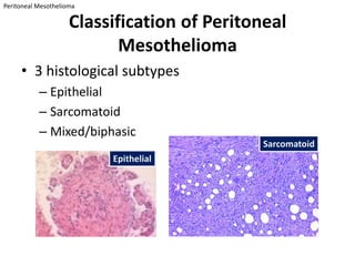 Peritoneal Mesothelioma

                     Classification of Peritoneal
                            Mesothelioma
     • 3 histological subtypes
           – Epithelial
           – Sarcomatoid
           – Mixed/biphasic
                                              Sarcomatoid
                          Epithelial
 