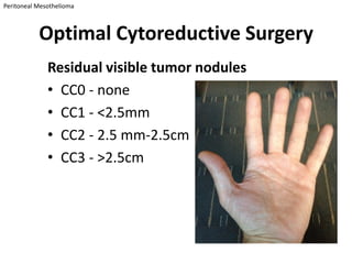 Peritoneal Mesothelioma



           Optimal Cytoreductive Surgery
              Residual visible tumor nodules
              • CC0 - none
              • CC1 - <2.5mm
              • CC2 - 2.5 mm-2.5cm
              • CC3 - >2.5cm
 