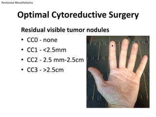 Peritoneal Mesothelioma



           Optimal Cytoreductive Surgery
              Residual visible tumor nodules
              • CC0 - none
              • CC1 - <2.5mm
              • CC2 - 2.5 mm-2.5cm
              • CC3 - >2.5cm
 