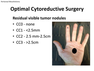 Peritoneal Mesothelioma



           Optimal Cytoreductive Surgery
              Residual visible tumor nodules
              • CC0 - none
              • CC1 - <2.5mm
              • CC2 - 2.5 mm-2.5cm
              • CC3 - >2.5cm
 