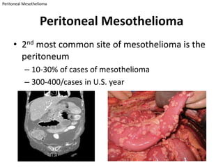 Peritoneal Mesothelioma



                   Peritoneal Mesothelioma
     • 2nd most common site of mesothelioma is the
       peritoneum
           – 10-30% of cases of mesothelioma
           – 300-400/cases in U.S. year
 