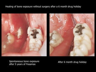 Gary leonard oral surgery ifpdc presentation to email compressed | PPTX