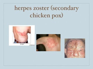 herpes zoster (secondary
     chicken pox)
 