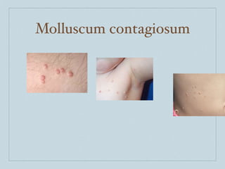 Molluscum contagiosum
 