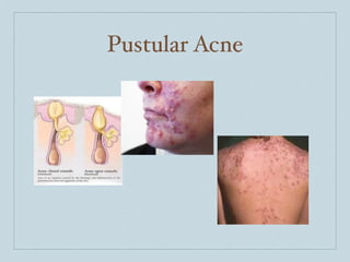 Pustular Acne
 