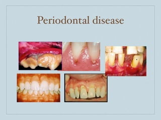 Periodontal disease
 