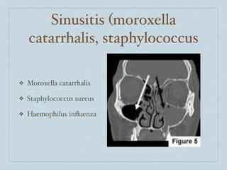 Sinusitis (moroxella
    catarrhalis, staphylococcus

❖   Moroxella catarrhalis

❖   Staphylococcus aureus

❖   Haemophilus inﬂuenza
 