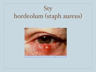 Sty
hordeolum (staph aureus)
 