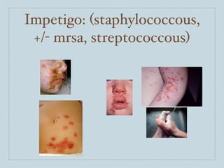 Impetigo: (staphylococcous,
 +/- mrsa, streptococcous)
 