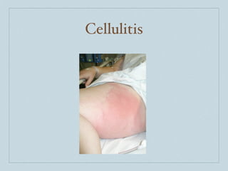 Cellulitis
 