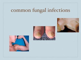 common fungal infections
 
