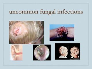 uncommon fungal infections
 