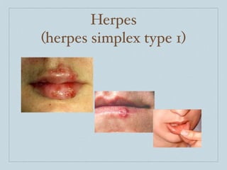 Herpes
(herpes simplex type 1)
 