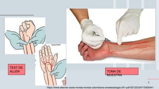 5
TEST DE
ALLEN TOMA DE
MUESTRA
https://www.elsevier.es/es-revista-revista-colombiana-anestesiologia-341-pdf-S0120334715000441
 