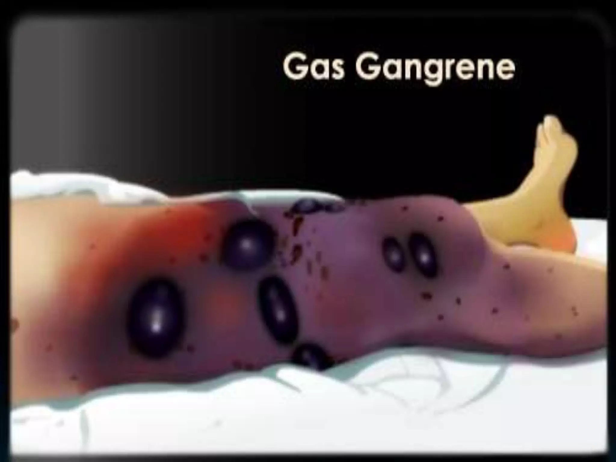 Gas gangrene PPT