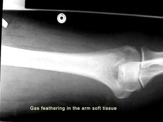Gas feathering in the arm soft tissue
 