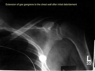 Extension of gas gangrene to the chest wall after initial debridementExtension of gas gangrene to the chest wall after initial debridement
 