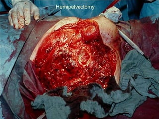 Hemipelvectomy
 