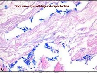 Gram stain of cysts with large rod-shaped bacteriaGram stain of cysts with large rod-shaped bacteria
 