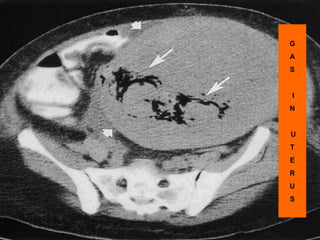 G
A
S
I
N
U
T
E
R
U
S
 