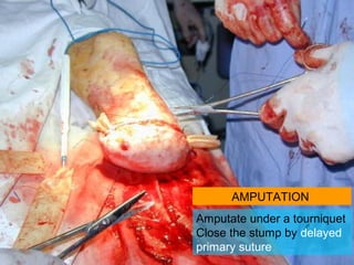 AMPUTATION
Amputate under a tourniquet
Close the stump by delayed
primary suture
 
