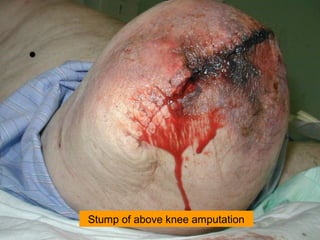 Stump of above knee amputation
 