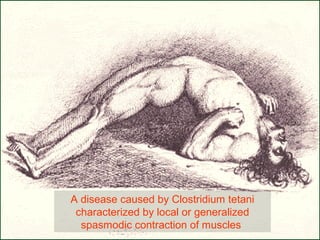 A disease caused by Clostridium tetani
characterized by local or generalized
spasmodic contraction of muscles
 