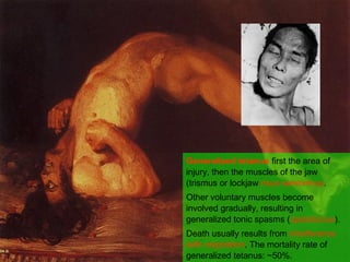 Generalized tetanus first the area of
injury, then the muscles of the jaw
(trismus or lockjaw risus sardonicus.
Other voluntary muscles become
involved gradually, resulting in
generalized tonic spasms (opistotonus).
Death usually results from interference
with respiration. The mortality rate of
generalized tetanus: ~50%.
 