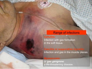 Cellulitis:
Infection with gas formation
in the soft tissue.
Fasciitis or suppurative myositis:
Infection and gas in the muscle planes.
Myonecrosis:
or gas gangrene:
a life-threatening disease.
Range of infections
 