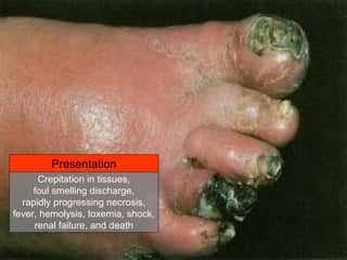 Crepitation in tissues,
foul smelling discharge,
rapidly progressing necrosis,
fever, hemolysis, toxemia, shock,
renal failure, and death
Presentation
 