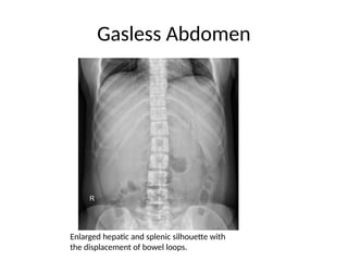 Gasless Abdomen and displaced bowel.pptx