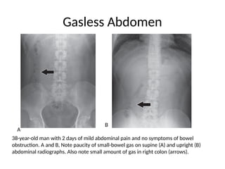 Gasless Abdomen and displaced bowel.pptx