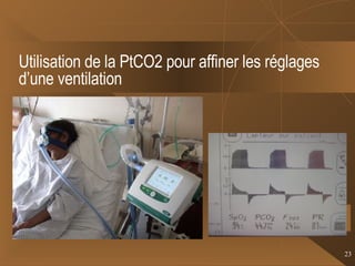 Utilisation de la PtCO2 pour affiner les réglages d’une ventilation 
