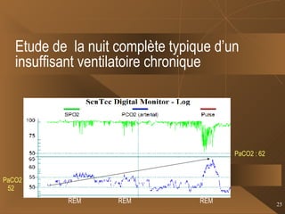 Etude de  la nuit complète typique d’un insuffisant ventilatoire chronique REM  REM   REM PaCO2 52 PaCO2 : 62 