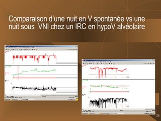 Comparaison d’une nuit en V spontanée vs une nuit sous  VNI chez un IRC en hypoV alvéolaire 