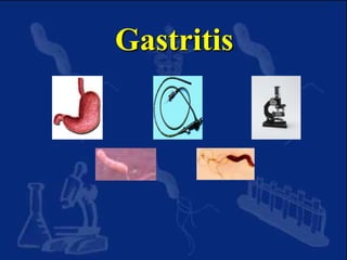 Gastritis
 
