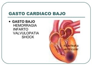 GASTO CARDIACO BAJO GASTO BAJO   HEMORRAGIA  INFARTO  VALVULOPATIA  SHOCK  