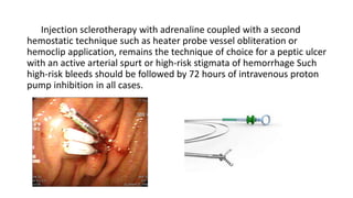 Injection sclerotherapy with adrenaline coupled with a second
hemostatic technique such as heater probe vessel obliteration or
hemoclip application, remains the technique of choice for a peptic ulcer
with an active arterial spurt or high-risk stigmata of hemorrhage Such
high-risk bleeds should be followed by 72 hours of intravenous proton
pump inhibition in all cases.
 