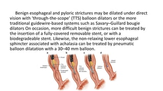 Benign esophageal and pyloric strictures may be dilated under direct
vision with ‘through-the-scope’ (TTS) balloon dilators or the more
traditional guidewire-based systems such as Savary–Guillard bougie
dilators On occasion, more difficult benign strictures can be treated by
the insertion of a fully-covered removable stent, or with a
biodegradeable stent. Likewise, the non-relaxing lower esophageal
sphincter associated with achalasia can be treated by pneumatic
balloon dilatation with a 30–40 mm balloon.
 